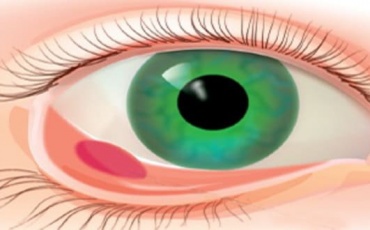 Что собой представляет мейбомит — внутренний ячмень на глазу, воспаляющийся внутри века: типичные симптомы заболевания, причины, эффективные методы...